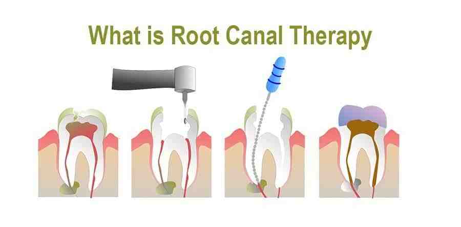 What can you do instead of a root canal?