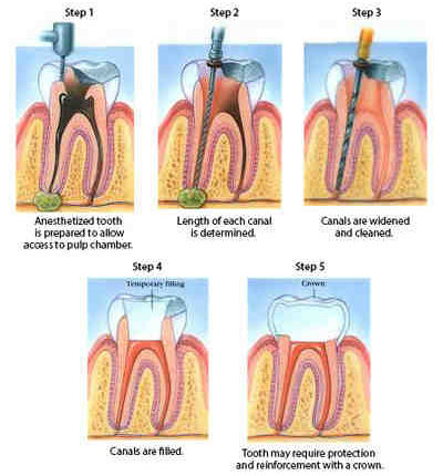 What can you get instead of a root canal? - Dental News Network