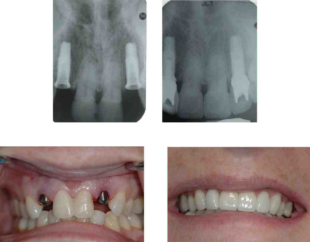 What can you not do after dental implants?