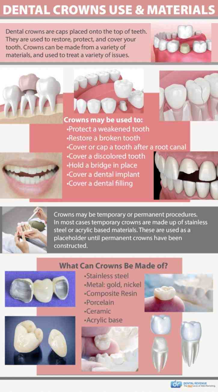 How much is a crown for a tooth? - Dental News Network