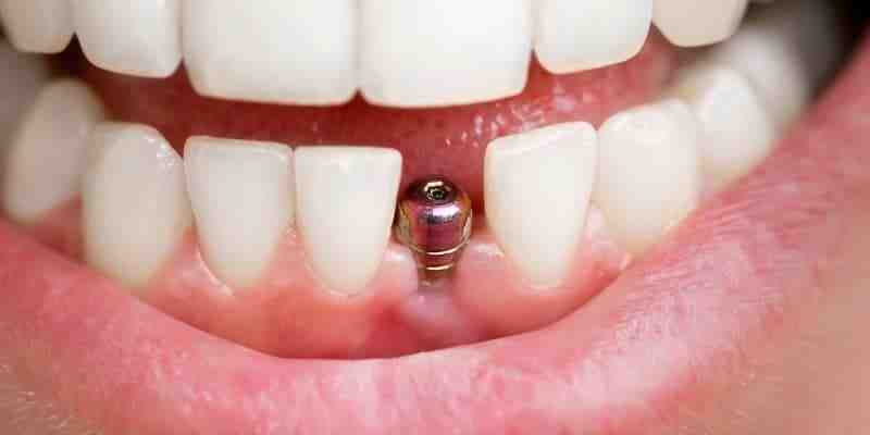 What causes a dental implant to fail?