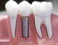 What color of veneers should I get?