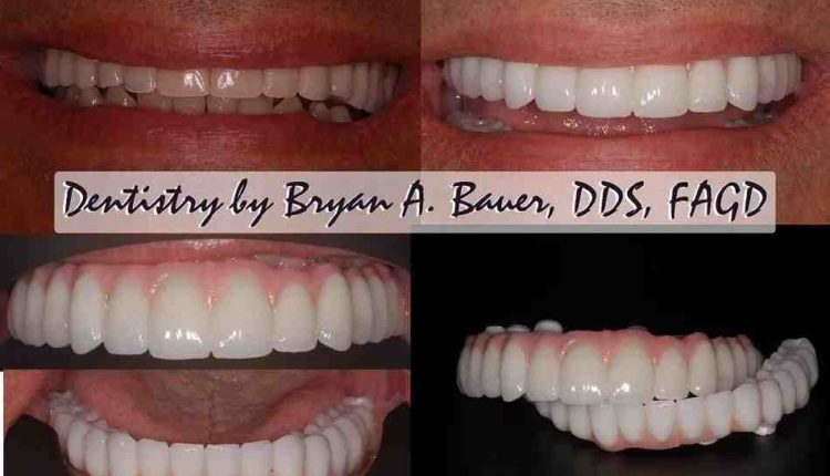 What do dental implants cost in usa