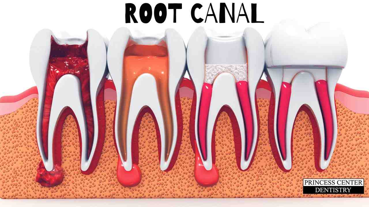 What happens if I don't get a root canal?