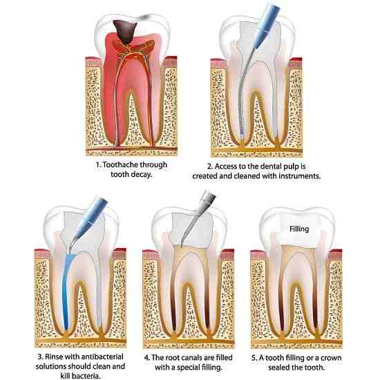 What happens if root canal doesn't work?