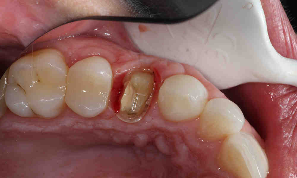 What Happens If Tooth Under Crown Decays Dental News Network