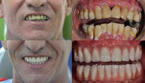What happens if you lose one tooth?