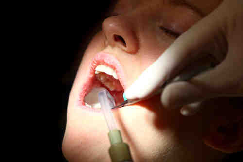 What holds a tooth in place after a root canal?