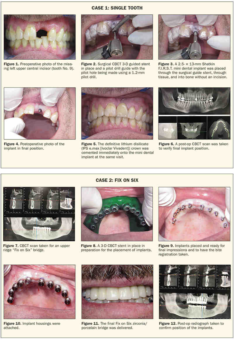 What holds dental implants in place?