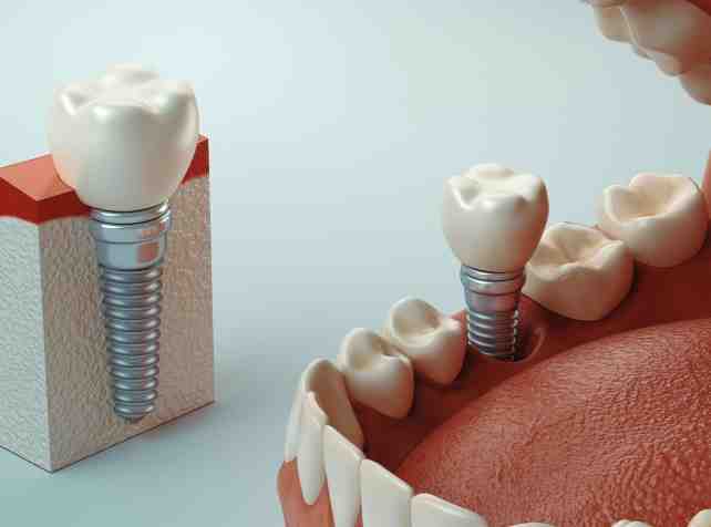 What hurts more tooth extraction or implant?