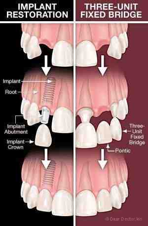What hurts more tooth extraction or implant?
