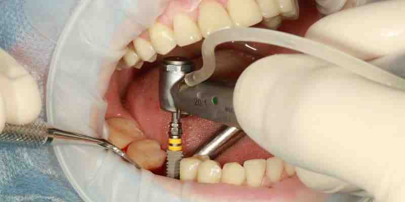 What hurts more tooth extraction or implant?