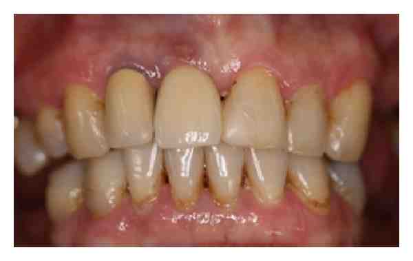 What hurts more tooth extraction or implant?