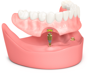 What hurts more tooth extraction or implant?