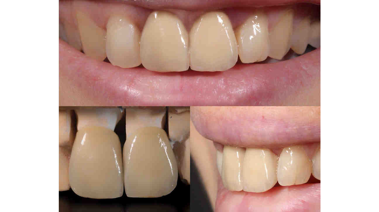 What is a cheaper alternative to a crown?