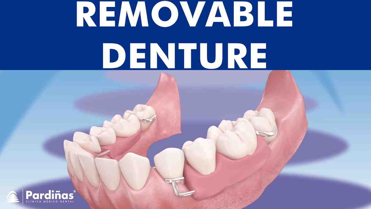 What is a flipper denture?