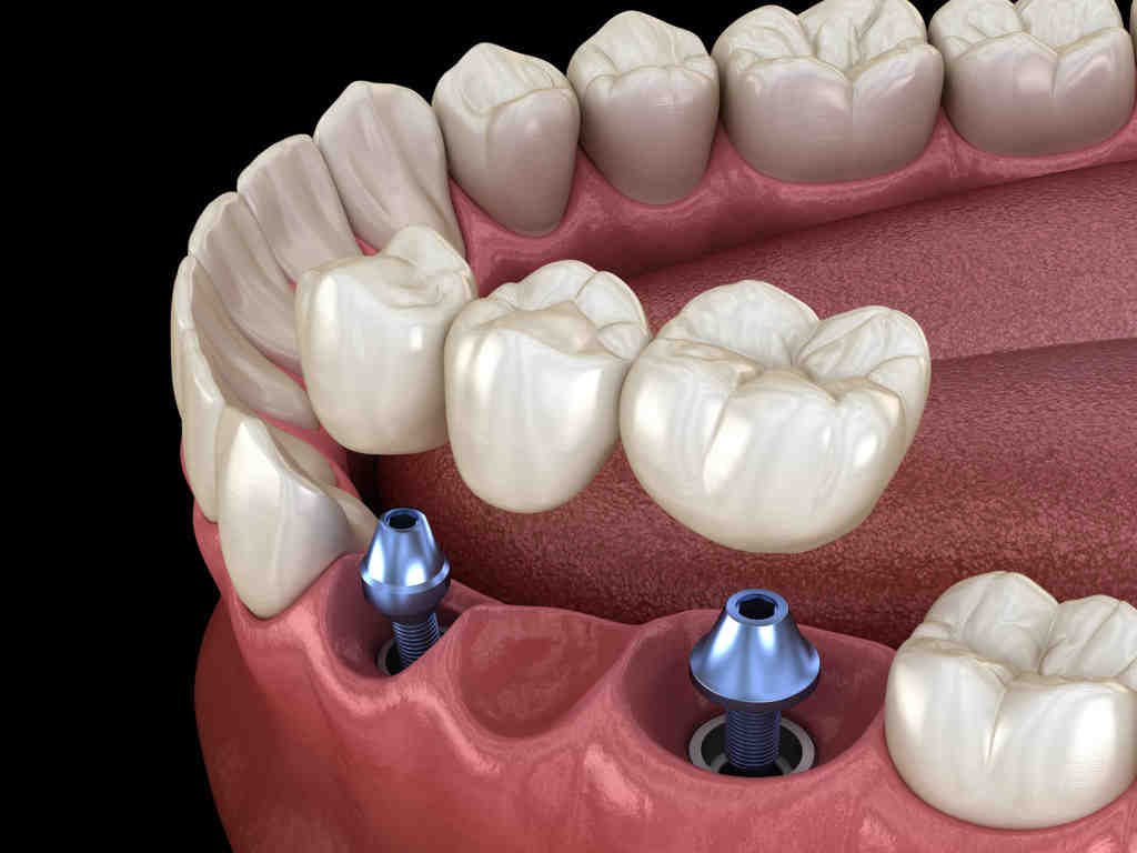 What is a single fake tooth called?