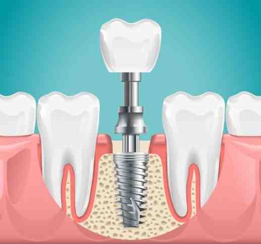 What is an alternative to a dental implant?