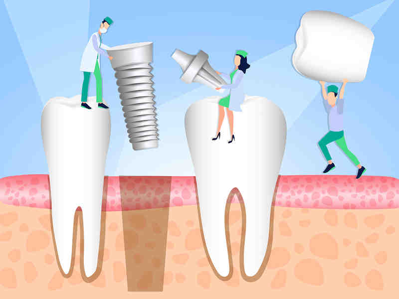 What is an alternative to dental implants?