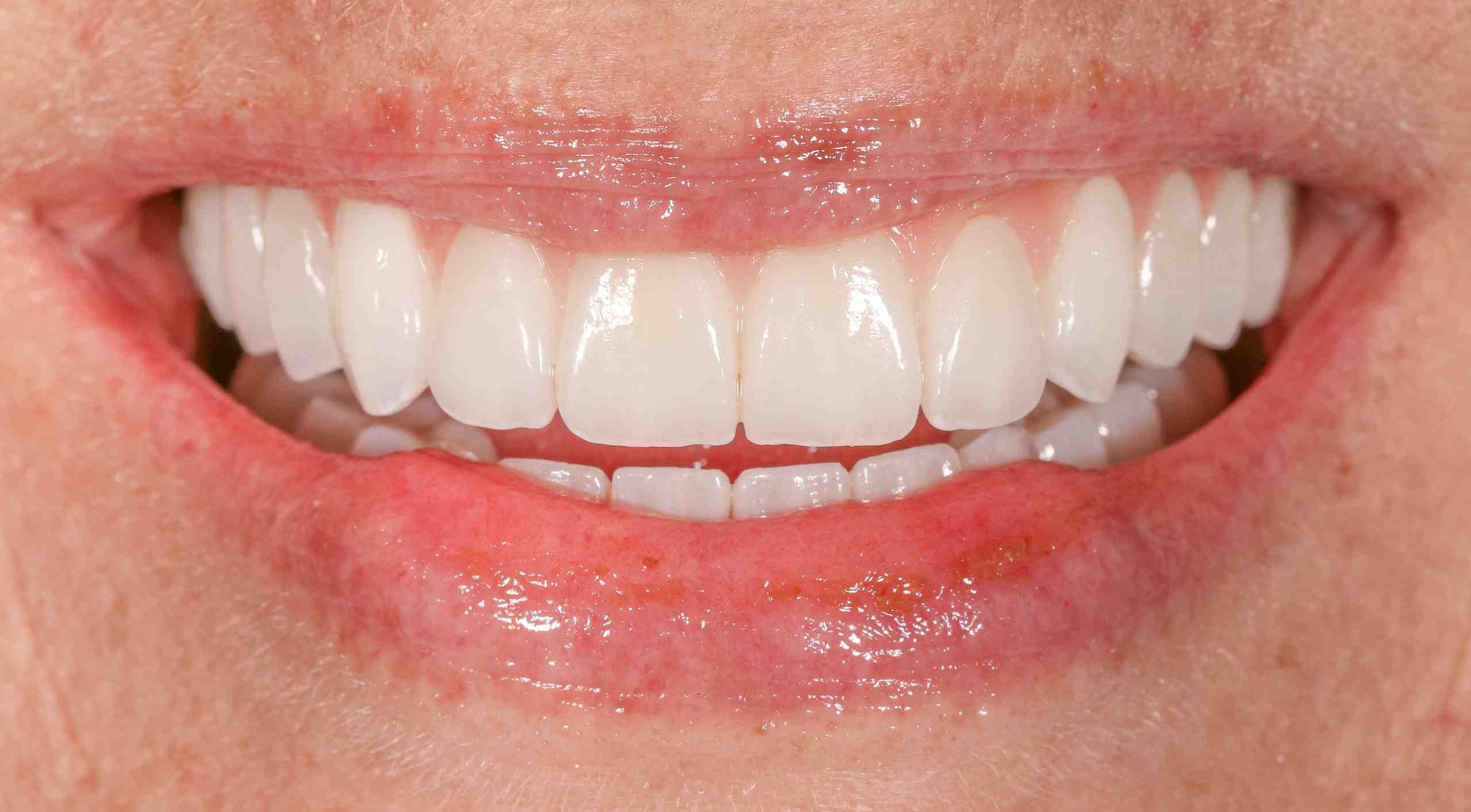 What is an autoimmune disease in the mouth?