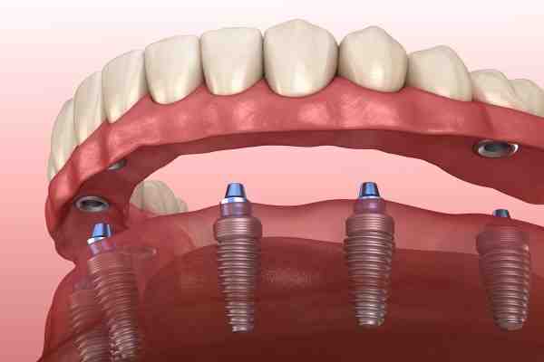 What is better Lumineers or veneers?
