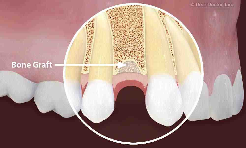 What is better bridge or implant?