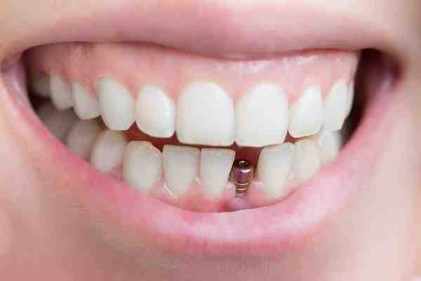 What is osteomyelitis caused by?