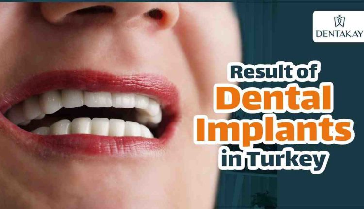 What is the average cost for a full set of dental implants