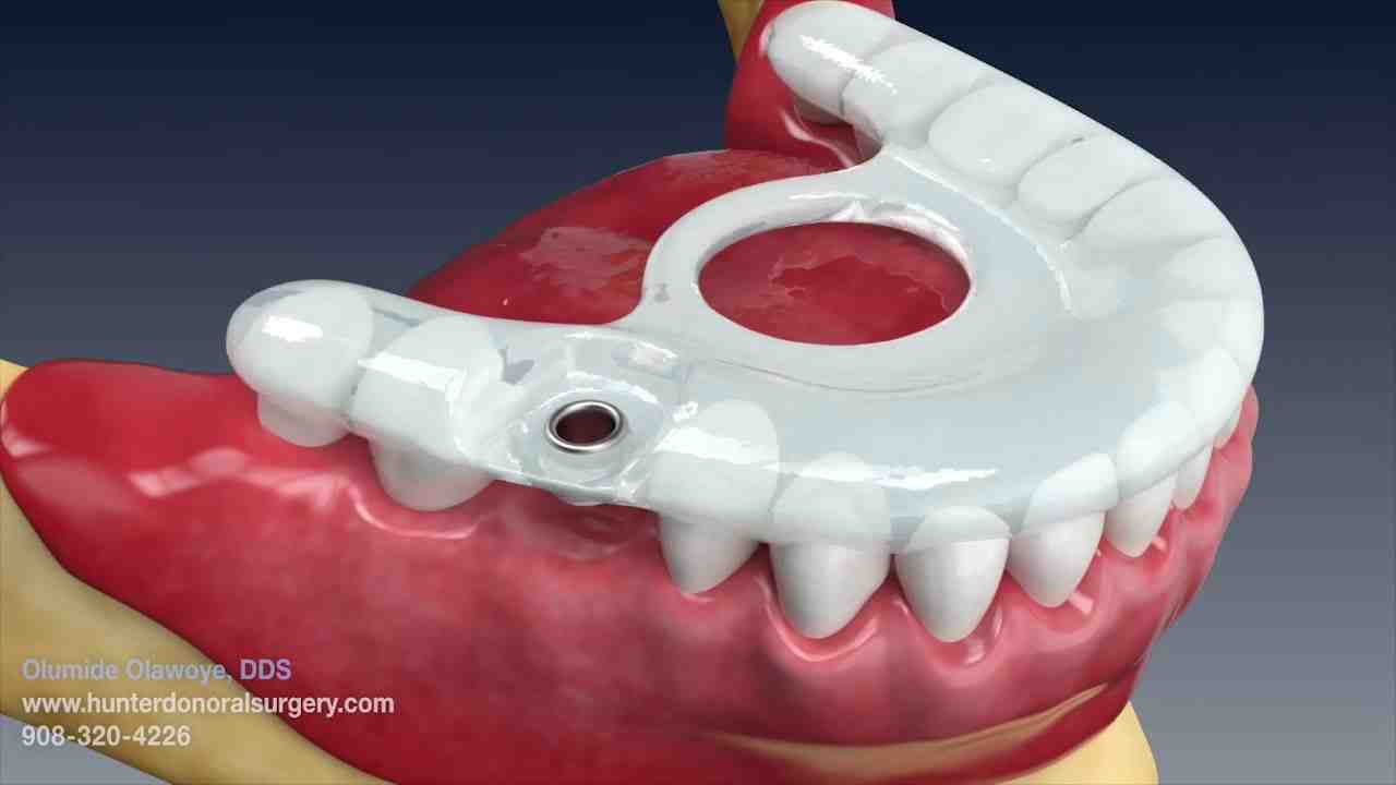 What is the best age for dental implants?