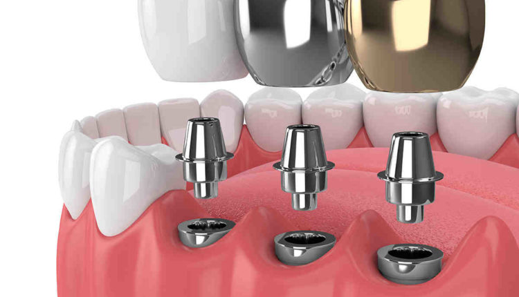 What is the best think to use for dental implant?