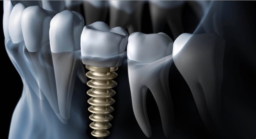 What is the downside of dental implants?