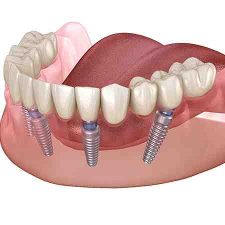 What is the downside of dental implants?