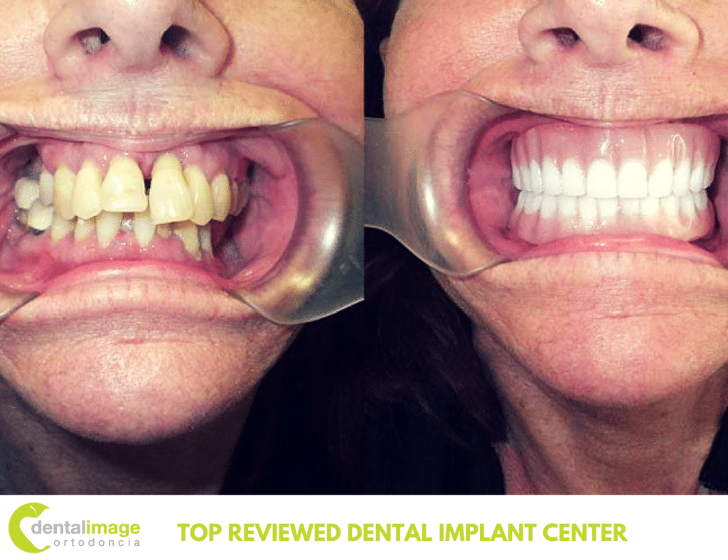 What is the failure rate of dental implants?