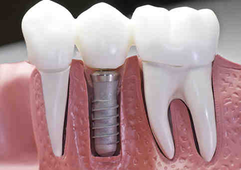 What is the most popular cosmetic dental procedure?