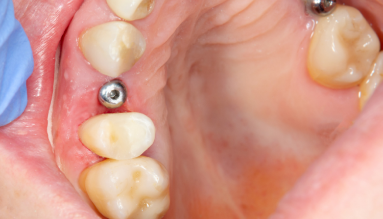 What to expect dental implant