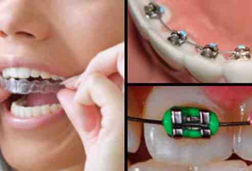 What's the longest time to wear braces?