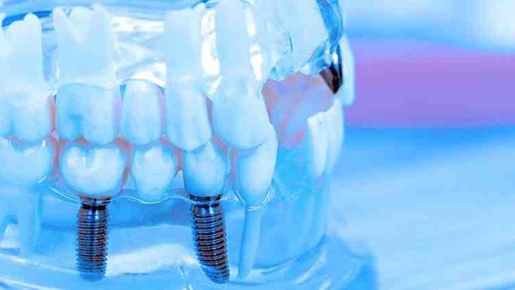 When are dental implants covered by insurance