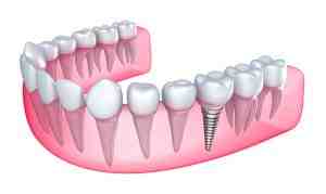 When can I drive after implant surgery?