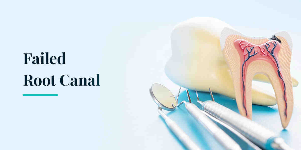 When does a tooth need to be pulled?