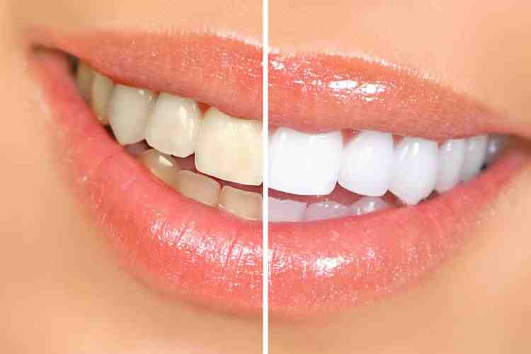 When is it too late for dental implants?