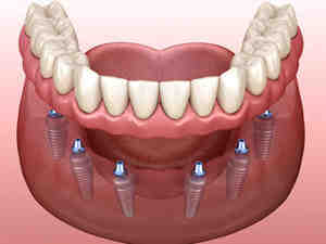When should you not get dental implants?