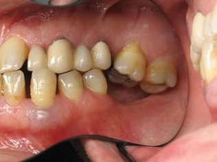 When should you not get dental implants?