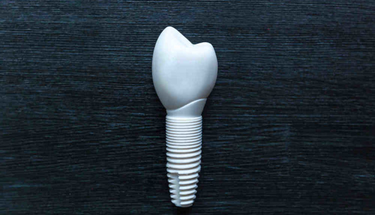 Where can i get dental implants for free