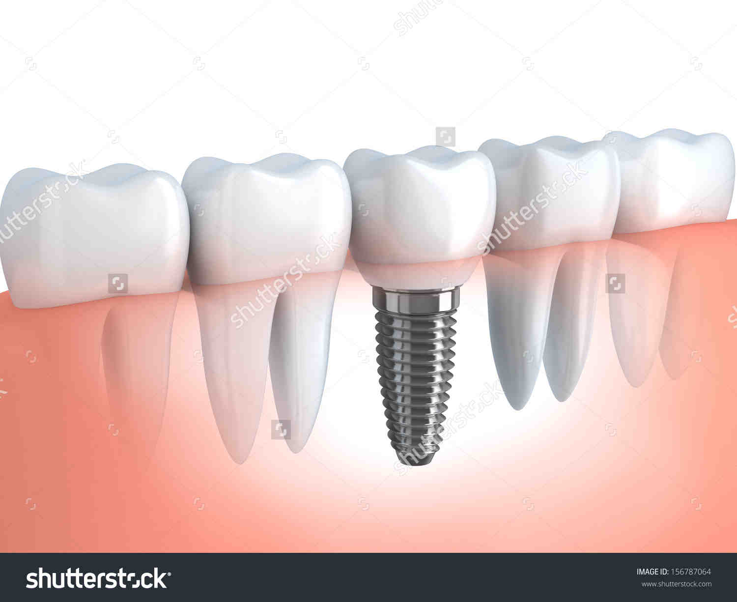 Where is the cheapest country to get teeth implants?