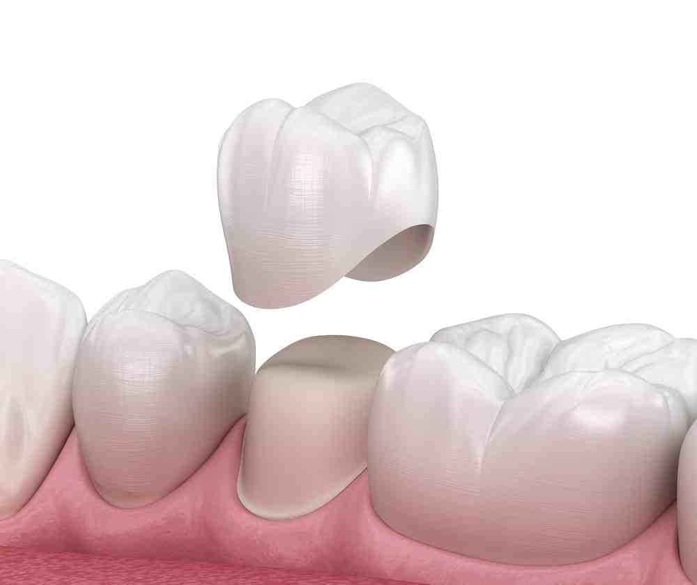 Which dental crown material is best?