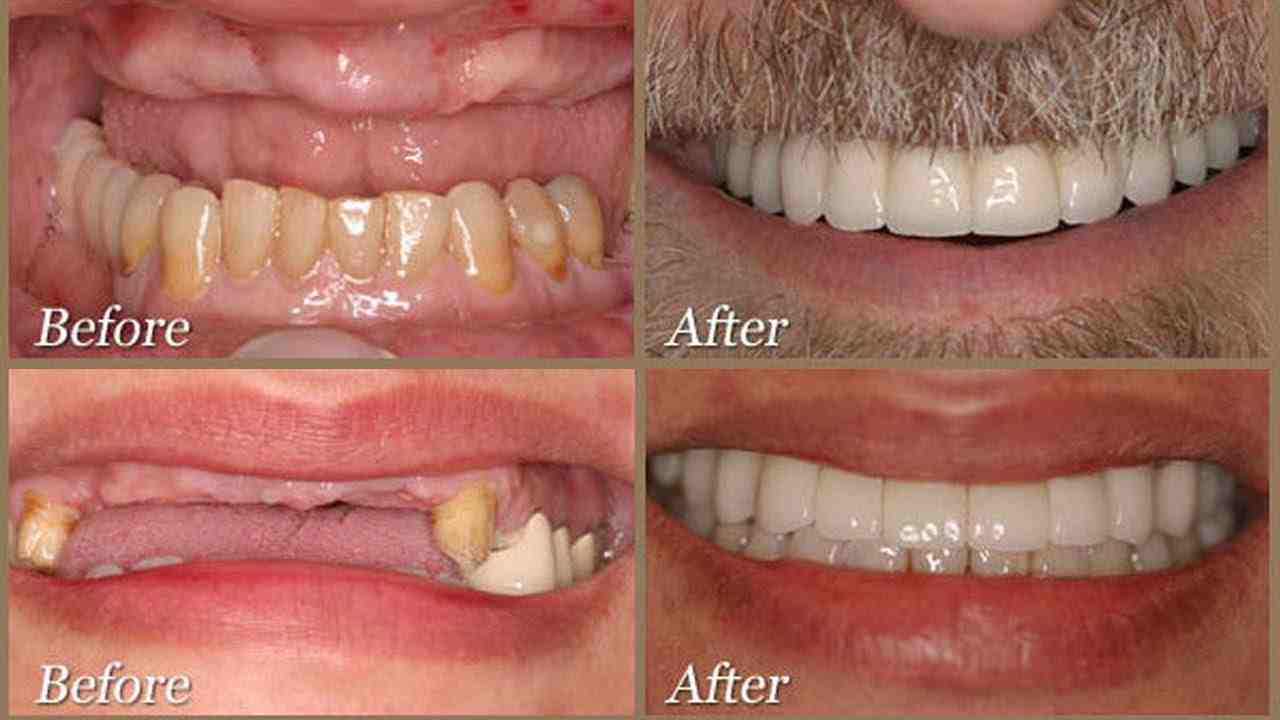Which is better all on 4 or all on 6 dental implants?
