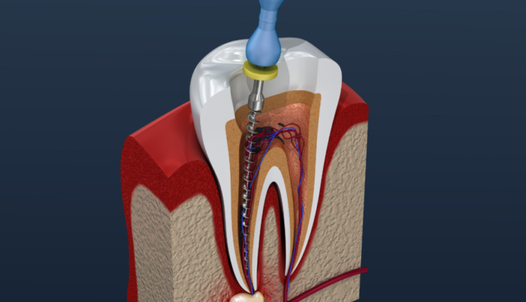 Which is better tooth extraction or root canal? - Dental News Network