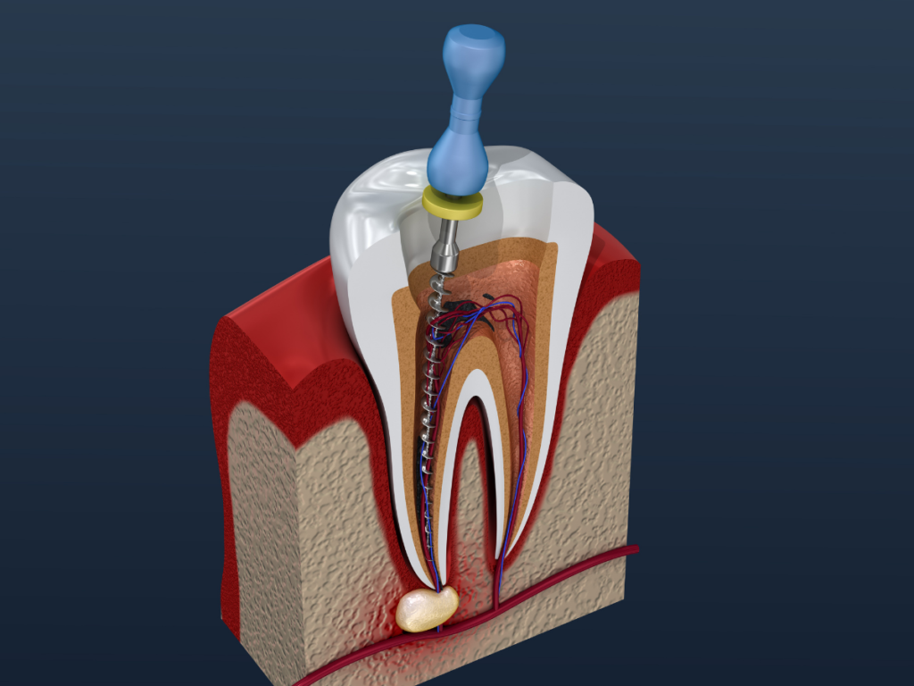 which-is-better-tooth-extraction-or-root-canal-dental-news-network