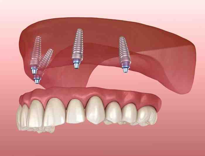 Which medical conditions can Contraindicate placement of implants?