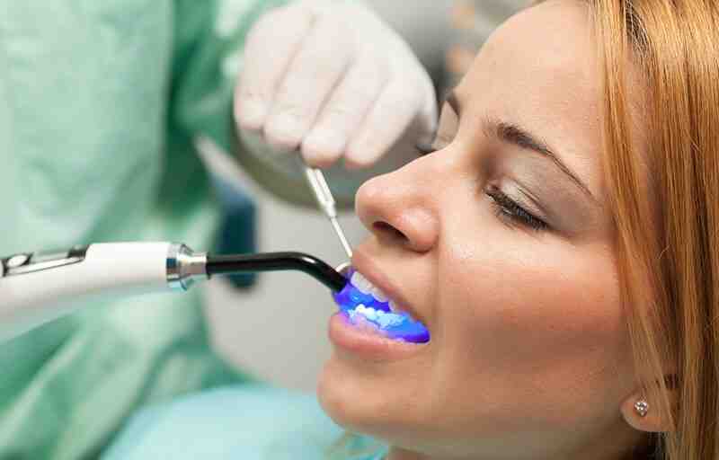 Which veneer looks most natural?